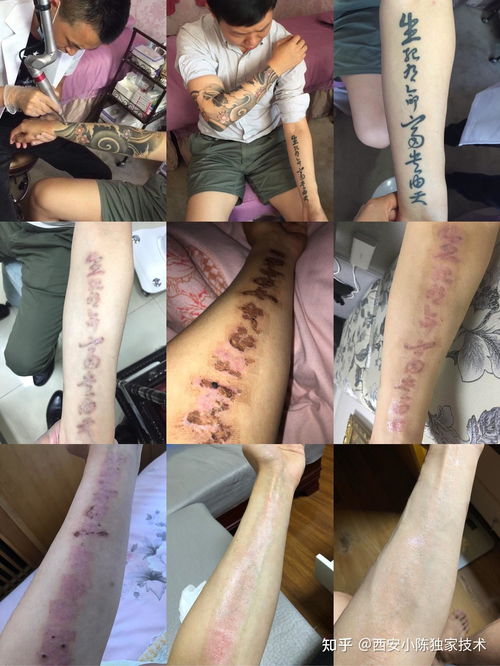 纹身能否去除？揭秘纹身去除的秘密
